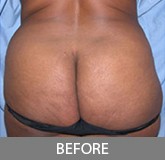 Liposuction before and after - before