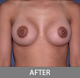 Breast Augmentation before and after - after
