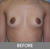 Breast Augmentation before and after - before