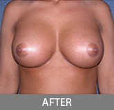 Breast Augmentation before and after - after