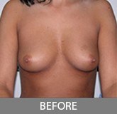 Breast Augmentation before and after - before