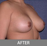 Breast Augmentation before and after - after