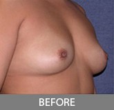 Breast Augmentation before and after - before