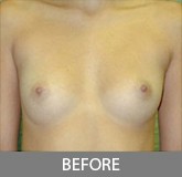 Breast Augmentation before and after - before
