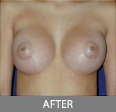 Breast Augmentation before and after - after