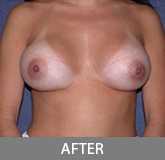 Breast Augmentation before and after - after