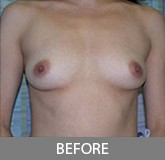Breast Augmentation before and after - before