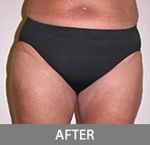 Liposuction before and after - after