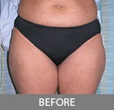 Liposuction before and after - before