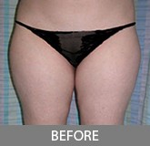 Liposuction before and after - before