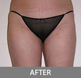 Liposuction before and after - after
