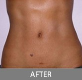 Liposuction before and after - after