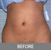 Liposuction before and after - before