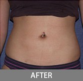 Liposuction before and after - after