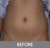Liposuction before and after - before