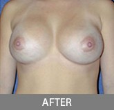 Breast Augmentation before and after - after