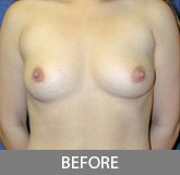 Breast Augmentation before and after - before