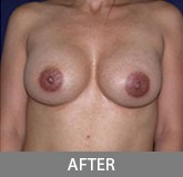 Breast Augmentation before and after - after