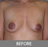 Breast Augmentation before and after - before