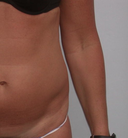 Liposuction after — Dr. Howard Gross