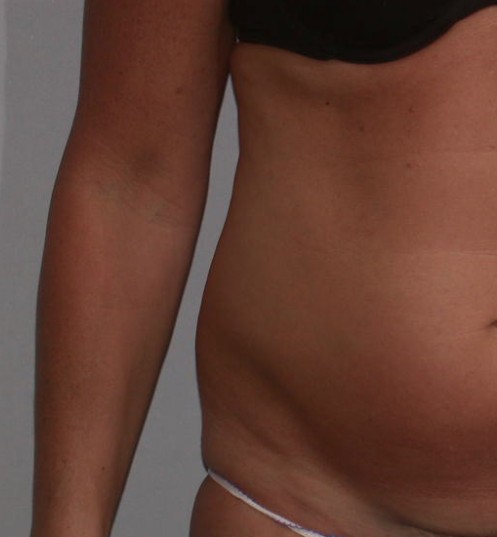 Liposuction before — Dr. Howard Gross