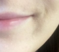 Procedure before and after - after