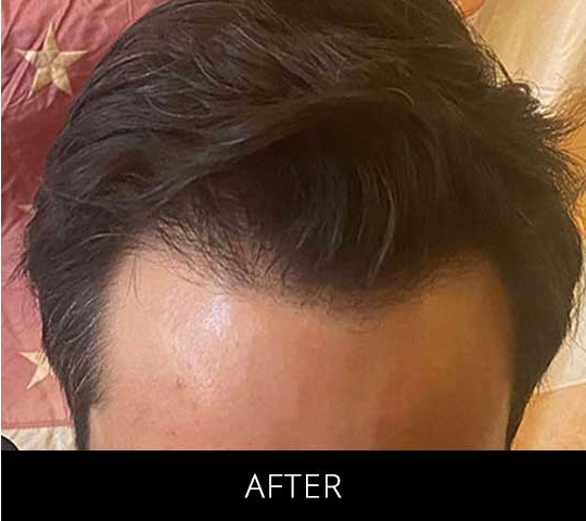 Robotic Hair Restoration before and after - after
