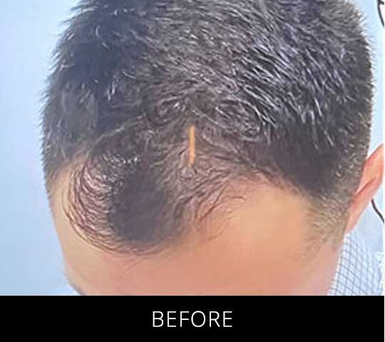 Robotic Hair Restoration before and after - before