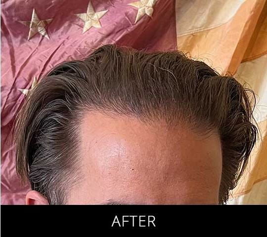 Robotic Hair Restoration before and after - after