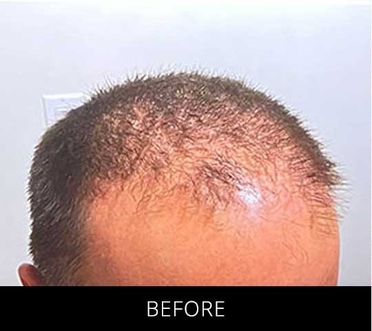 Robotic Hair Restoration before and after - before