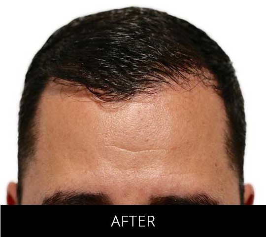 Robotic Hair Restoration before and after - after