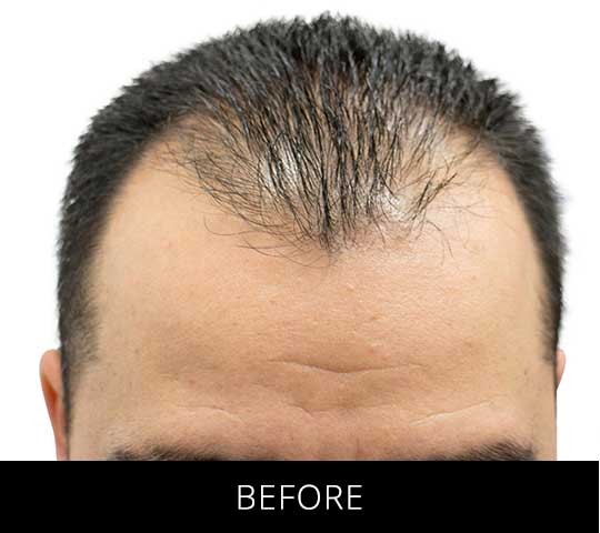 Robotic Hair Restoration before and after - before