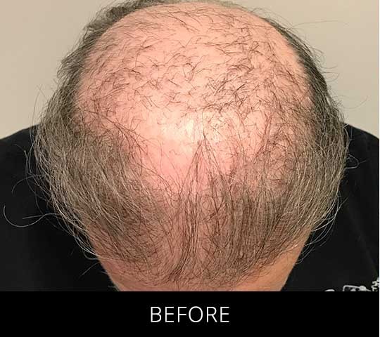 Robotic Hair Restoration before and after - before