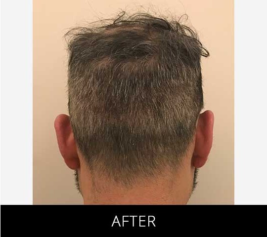 Scalp Camo before and after - after