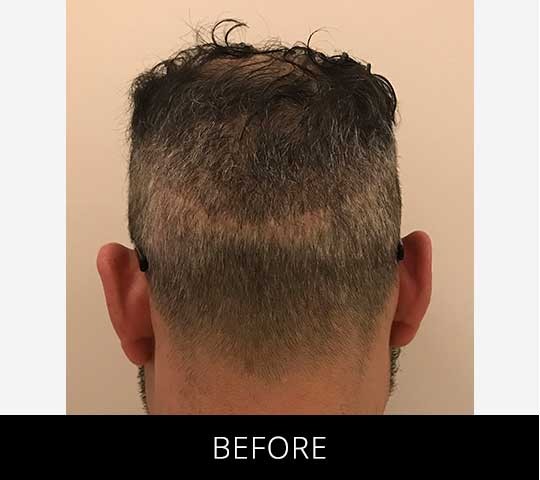 Scalp Camo before and after - before