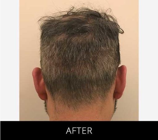 Scalp Camo before and after - after