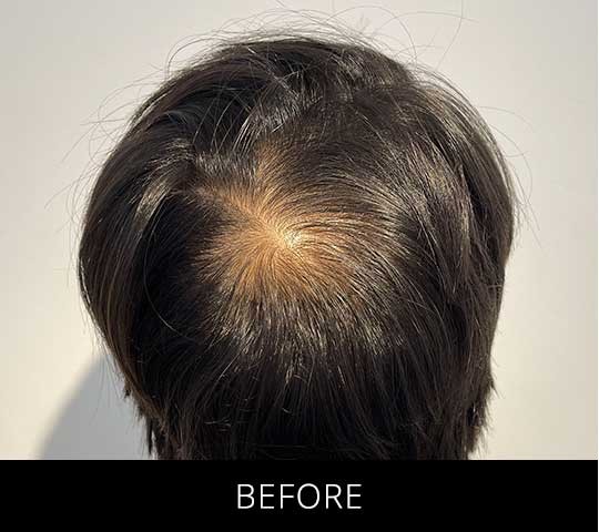 Scalp Camo before and after - before
