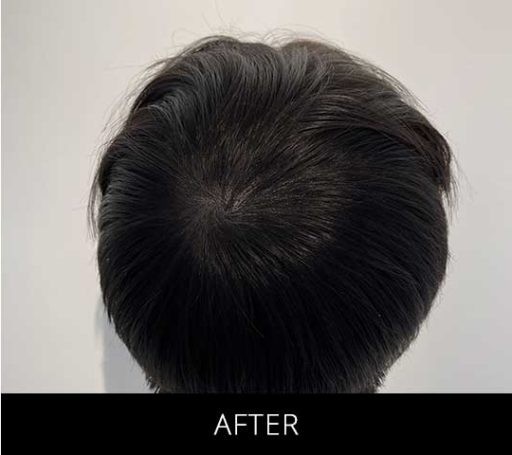 Scalp Camo before and after - after