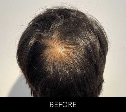 Scalp Camo before and after - before