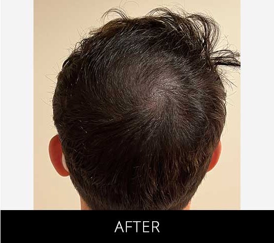 Scalp Camo before and after - after