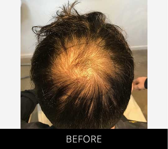 Scalp Camo before and after - before