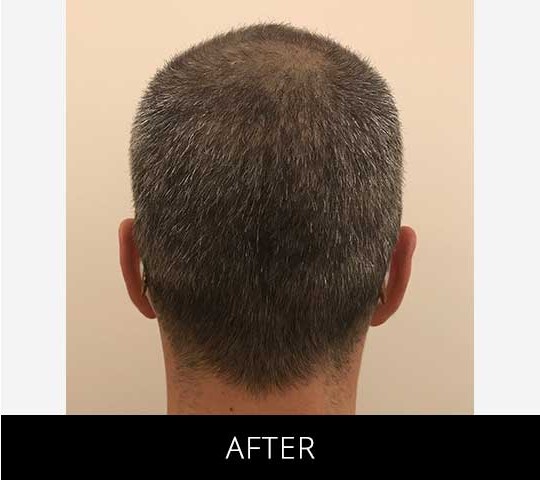 Scalp Camo before and after - after