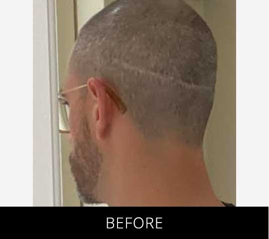 Scalp Camo before and after - before