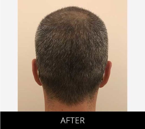 Scalp Camo before and after - after