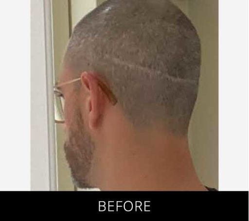 Scalp Camo before and after - before
