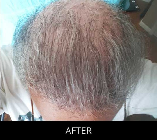 Robotic Hair Restoration before and after - after