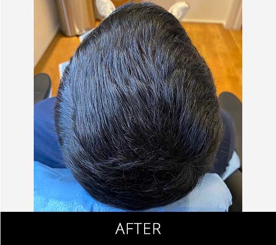 Scalp Camo before and after - after