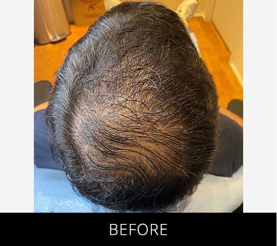 Scalp Camo before and after - before