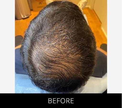 Scalp Camo before and after - before