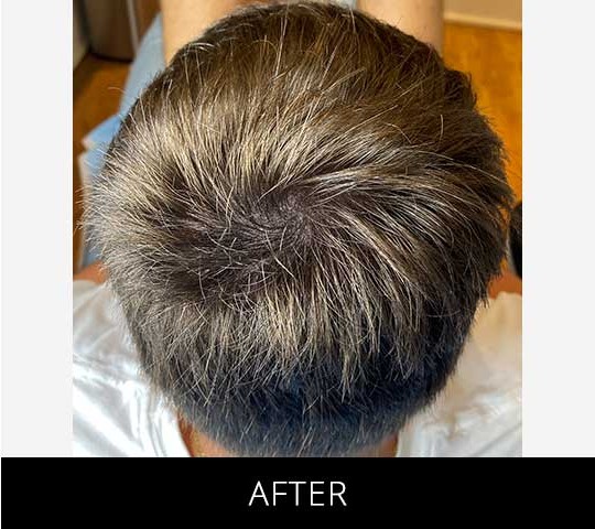 Scalp Camo before and after - after